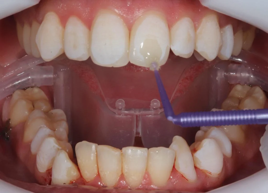application adhesif Le collage - Aligneurs Orthosafe