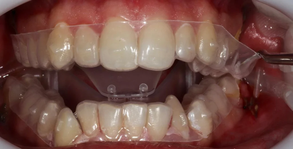 desinsertion gouttiere collage Le collage - Aligneurs Orthosafe