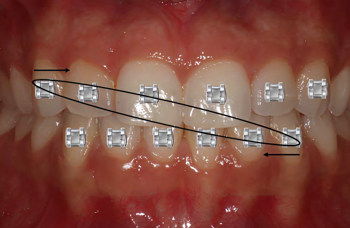 elastiques diagonale Charte de collage des brackets : comment choisir la bonne hauteur ? Orthosafe