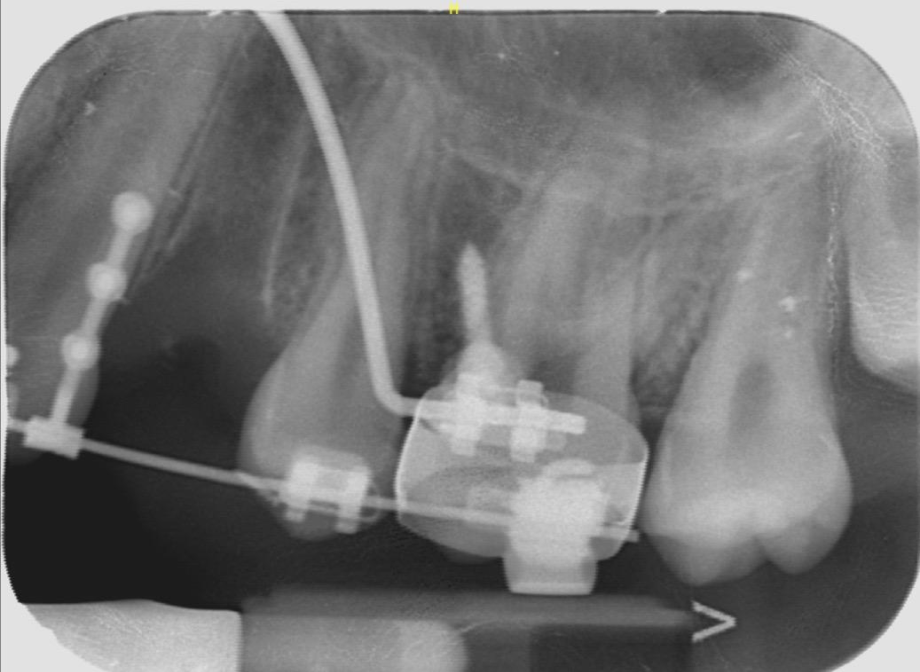 minivis 1 Mécaniques et dispositifs orthodontiques : guide des techniques et protocoles Orthosafe