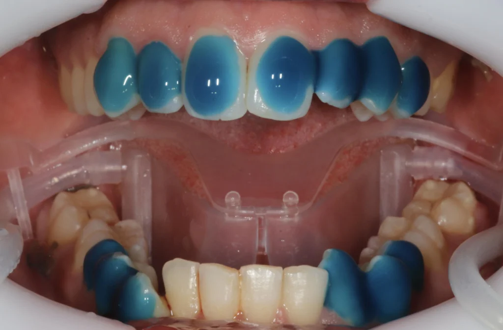 mordancage 1024x673 Le collage - Aligneurs Orthosafe