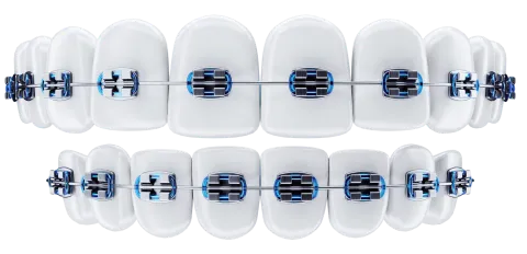 appareil multi attaches bagues  Orthosafe